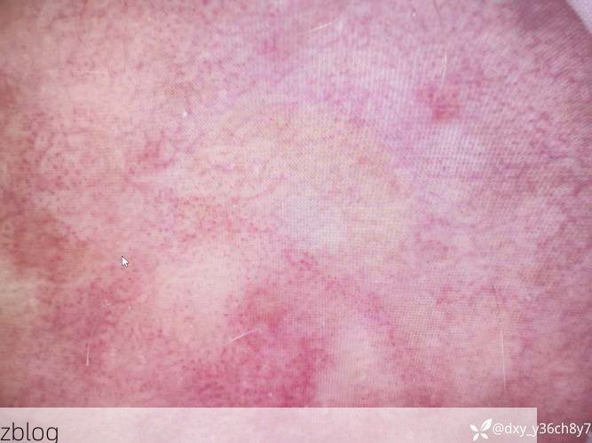 丘北：滇东南喀斯特屏障下的低感染样本